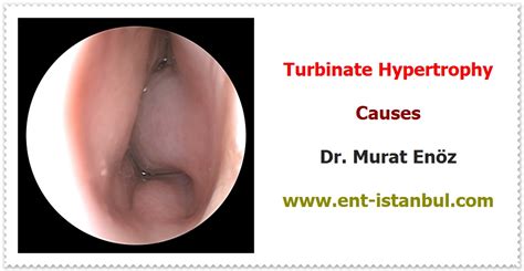 Turbinate Hypertrophy - Definition, Symptoms, Causes and Treatment