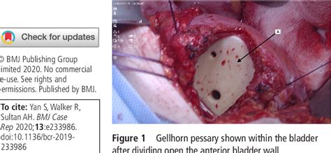 Figure 1 from Open removal of a migrated Gellhorn pessary and repair of a vesicovaginal fistula ...