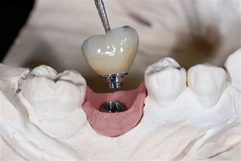 Screw Retained Dental Implant Crown and Bridge for Dental Lab ...