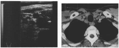 Axial sonogram of the right supraclavicular fossa in a patient with... | Download Scientific Diagram