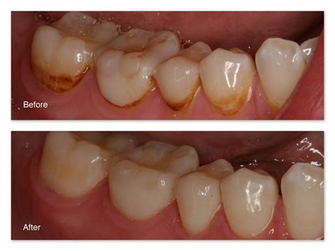 Remove Brown Stains In Between Teeth - TeethWalls