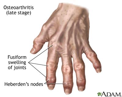 Arthritis: MedlinePlus Medical Encyclopedia