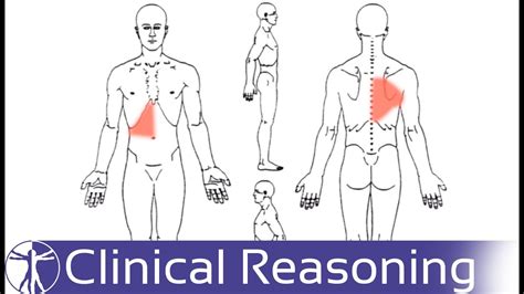 Spine Referred Pain Chart