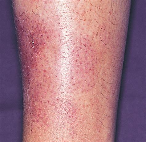 Primary Cutaneous Natural Killer/ T-Cell Lymphoma | Hematology | JAMA Dermatology | The JAMA Network