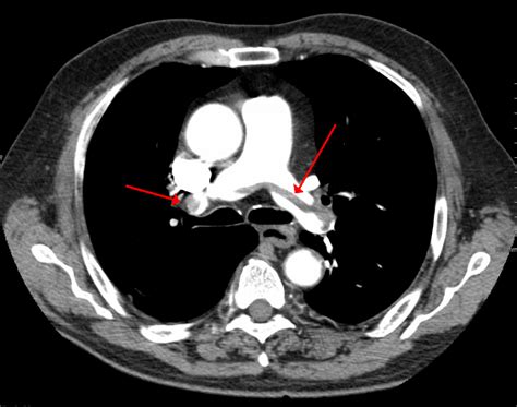 Blood clot in lung