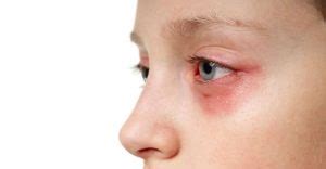 Allergic Shiners - Causes and Treatments