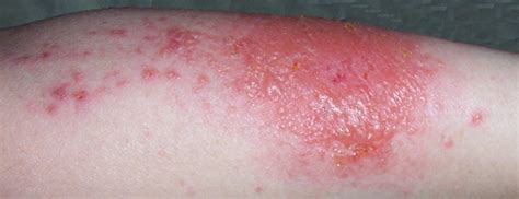 Contact Dermatitis, Scabies, Staph, Strep, or MRSA. Name that Rash.