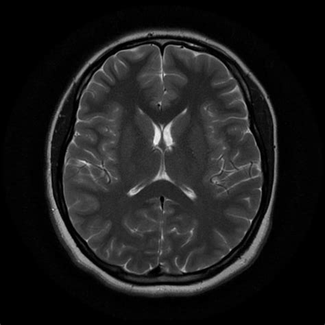 Mri Brain Mri Brain Normal Report - Gambaran