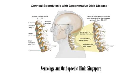 Cervical Spondylosis