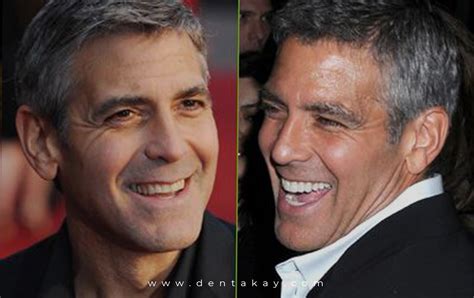 6 Shocking celebrity veneers with before & after pictures