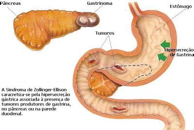 Zollinger-Ellison Syndrome Causes, Symptoms, Diagnosis and Treatment - Natural Health News