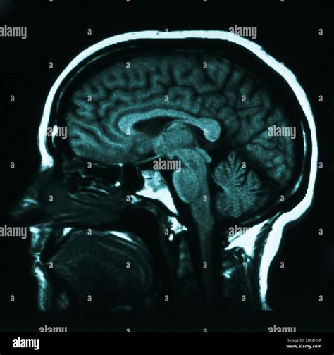 Cerebellum Anatomy Mri