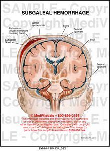 Medivisuals Subgaleal Hemorrhage Medical Illustration