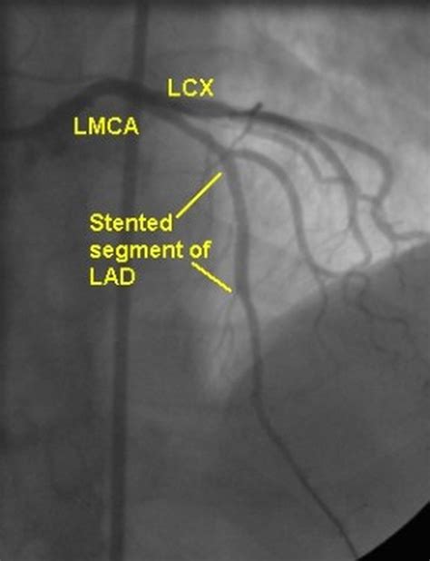 PTCA stenting of LAD total occlusion – All About Cardiovascular System and Disorders