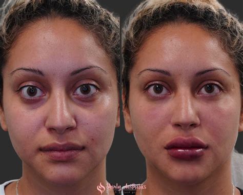 Under Eye Fillers - Before & After Results at Skinly