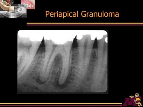 PPT - Periodontal And Periapical Diseases PowerPoint Presentation - ID:225272