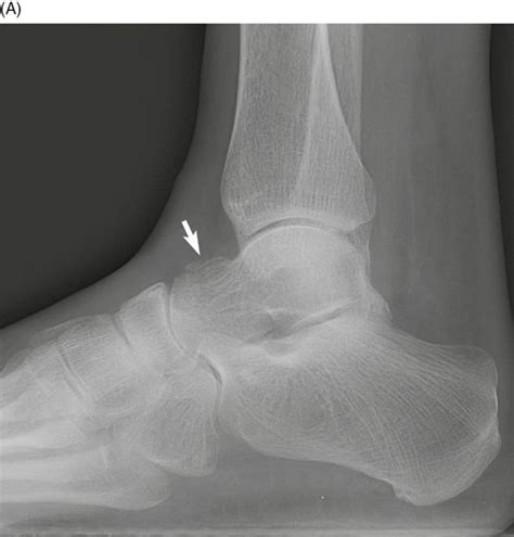 Talus Avulsion Fracture Treatment