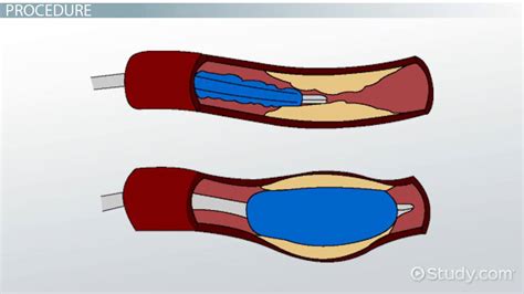 Angioplasty Definition, Procedure & Recovery - Video & Lesson ...