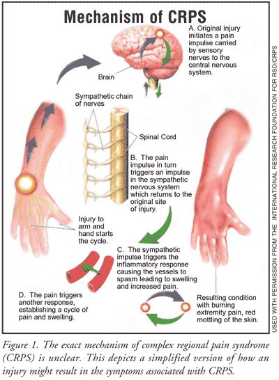 Guest Blog: Complex Regional Pain Syndrome - Capital Area PT & Wellness