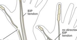 Tendon Transfer Surgery: Risks & Benefits | The Hand Society