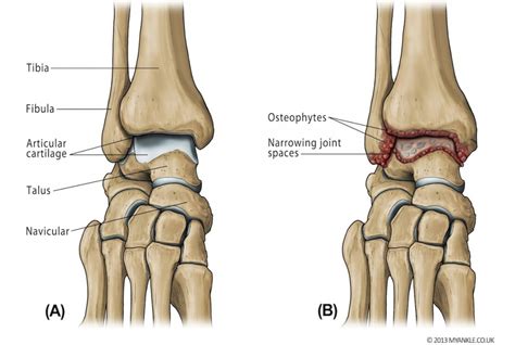 Types of arthritis that affects the knees - kneesafe.com