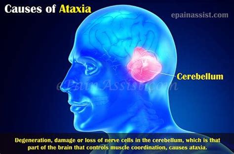 What Can Cause Ataxic Gait or Gait Ataxia? | Healthy Living | Cerebellar ataxia, Physical ...