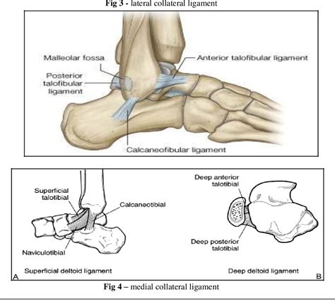 [PDF] Functional Outcome of Bimalleolar Ankle Fractures Treated With ...