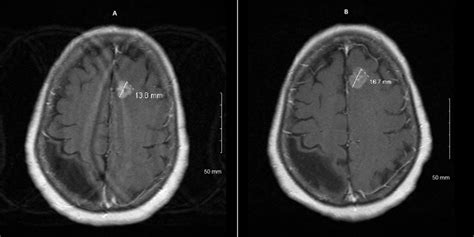 Ring enhancing brain lesions in a patient with Acquired Immunodeficiency Syndrome (AIDS): a ...