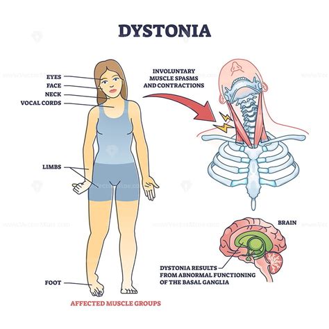 Focal dystonia as anatomical neurological muscle disorder outline diagram - VectorMine