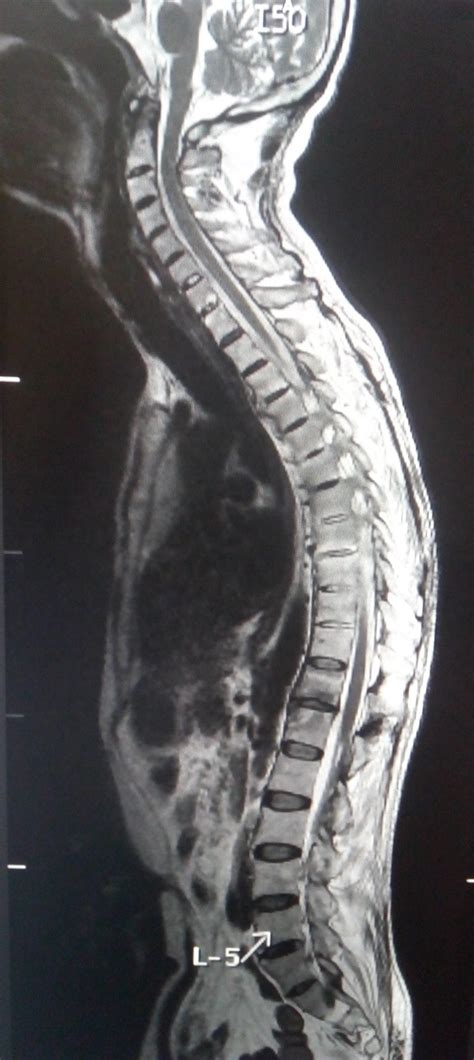 Ankylosing Spondylitis: MRI - Sumer's Radiology Blog