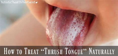 How to Treat “Thrush Tongue” Naturally - Holistic Health Herbalist