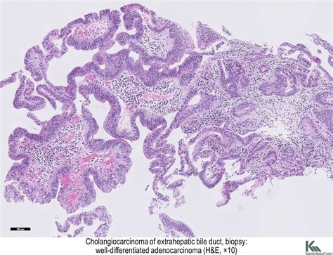 Pathology Outlines - Carcinoma of extrahepatic bile ducts