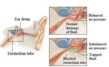 Eustachian Tube Dysfunction Treatment, Symptoms, What is