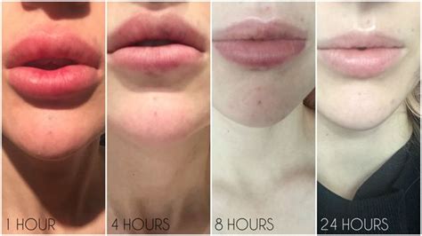 Lip Filler Removal Guide: From How Hyaluronidase Works, To Picking A ...