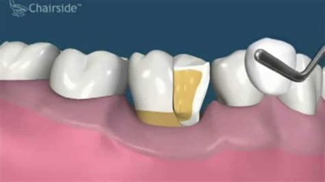 Crown Lengthening - Kentucky Periodontics and Implant Dentistry