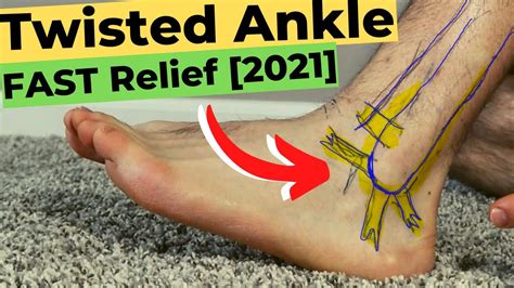 High Ankle Sprain Recovery Time: *The Best Treatment Guide!*