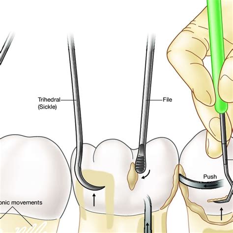 1 Periodontal instruments | Download Table