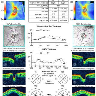 Average RNFL thickness is asymmetrical in both eyes with 58% of... | Download Scientific Diagram