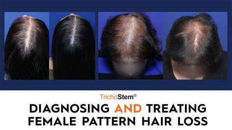 Top 48 image treating women's hair loss - Thptnganamst.edu.vn