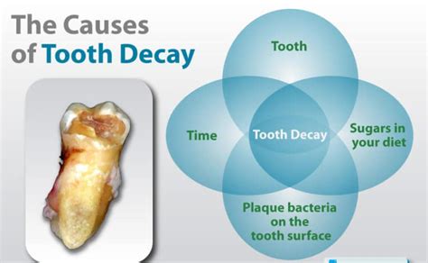 tooth-decay-causes - ABC Dental