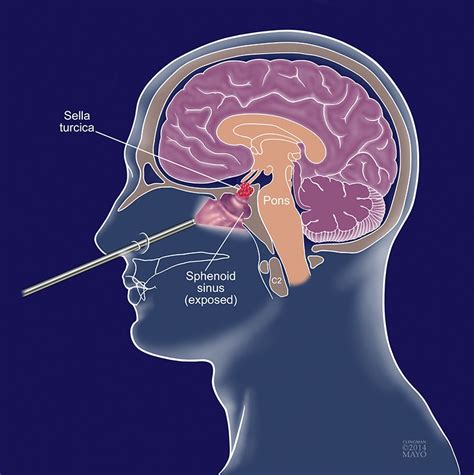 Advances in endoscopic pituitary surgery - For Medical Professionals - Mayo Clinic