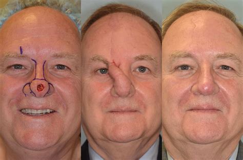 Paramedian Forehead Flap