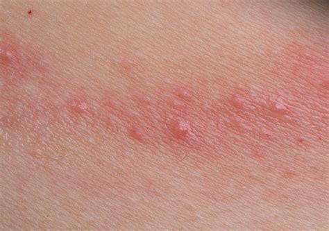 Contact Dermatitis: Causes and Risk Factors