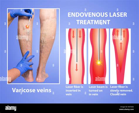 Understanding Varicose Veins: Causes, Symptoms, and Treatment Options – IngeCon