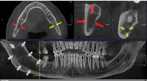 Figure 2 from Common conditions associated with mandibular canal widening: A literature review ...