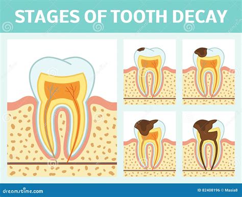 Tooth decay stages stock illustration. Illustration of disease - 82408196