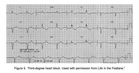 Subsection: Basic Science Trifascicular Block: Diagnosis and Anaesthetic Considerations : WFSA ...