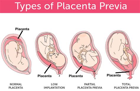 Abruptio Placenta Anatomy