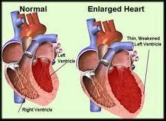 Cardiomegaly - Definition, Symptoms, Causes, Diagnosis and Treatment