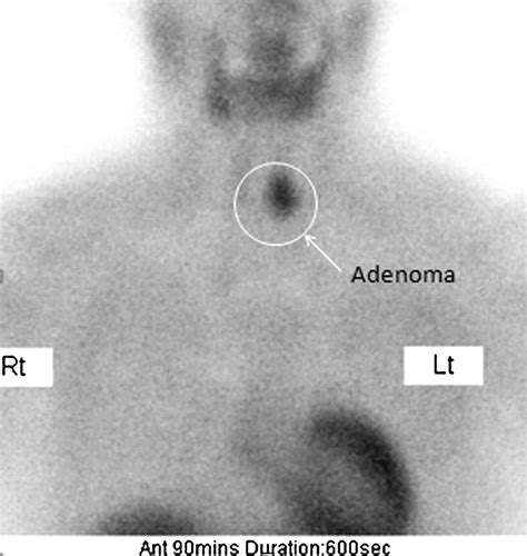 Parathyroid Imaging and Localization Using SPECT/CT: Initial Results | Journal of Nuclear ...